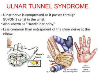 ULNAR TUNNEL SYNDROME
Ulnar nerve is compressed as it passes through
GUYON’S canal in the wrist.
• Also known as “Handle bar palsy”
Less common than entrapment of the ulnar nerve at the
elbow.
 