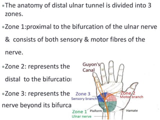 The anatomy of distal ulnar tunnel is divided into 3
zones.
Zone 1:proximal to the bifurcation of the ulnar nerve
& consists of both sensory & motor fibres of the
nerve.
Zone 2: represents the motor branch of the ulnar N
distal to the bifurcation.
Zone 3: represents the sensory branches of the ulnar
nerve beyond its bifurcation
 
