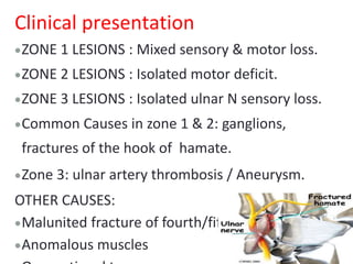 Clinical presentation
ZONE 1 LESIONS : Mixed sensory & motor loss.
ZONE 2 LESIONS : Isolated motor deficit.
ZONE 3 LESIONS : Isolated ulnar N sensory loss.
Common Causes in zone 1 & 2: ganglions,
fractures of the hook of hamate.
Zone 3: ulnar artery thrombosis / Aneurysm.
OTHER CAUSES:
Malunited fracture of fourth/fifth metacarpal.
Anomalous muscles
 