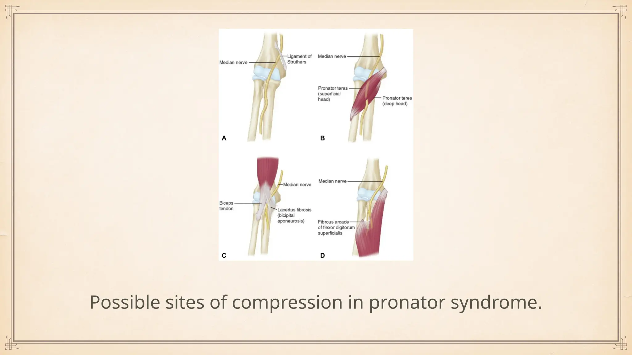 Possible sites of compression in pronator syndrome.
 