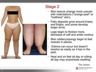 Patient with stage 2 lipedema (A), showing a slight improvement
