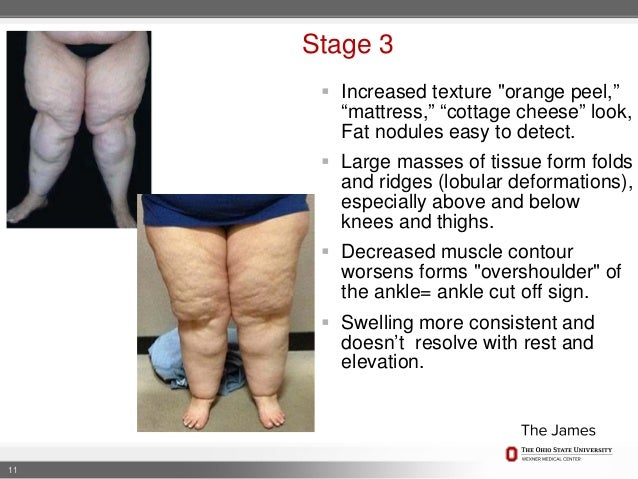 Lipedema Clinical Presentation And Treatment
