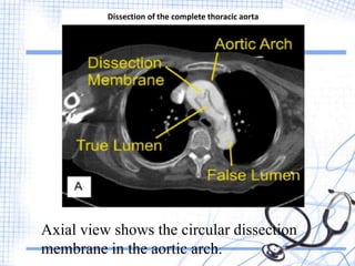 Complete Arch Dissection Computed Tomography and Spiral Computed Tomography | PPTX