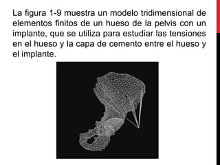 La figura 1-9 muestra un modelo tridimensional de
elementos finitos de un hueso de la pelvis con un
implante, que se utiliza para estudiar las tensiones
en el hueso y la capa de cemento entre el hueso y
el implante.
 