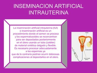 INSEMINACION ARTIFICIAL
INTRAUTERINA
La inseminación artificial intrauterina (IUI)
o inseminación artificial es un
procedimiento donde el semen se procesa
y los espermatozoides se reconcentran
para ser depositados posteriormente
en el útero usando un tubo (catéter)
de material sintético delgado y flexible.
Es necesario procesar adecuadamente
a los espermas ya
que de lo contrario podrían ocurrir dolorosas
complicaciones al depositarlos en el útero.
 