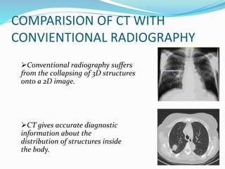 COMPARISION OF CT WITH
CONVIENTIONAL RADIOGRAPHY
Conventional radiography suffers
from the collapsing of 3D structures
onto a 2D image.
CT gives accurate diagnostic
information about the
distribution of structures inside
the body.
 