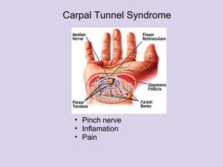Carpal Tunnel Syndrome Pinch nerve  Inflamation Pain 