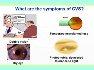 What are the symptoms of CVS? Double vision Dry eye Temporary nearsightedness Photophobia: decreased tolerance to light 