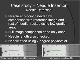 Case study – Needle Insertion Needle Detection. Needle end-point detected by comparison with reference image and rest of needle tracked using low-gradient area. Full image comparison done only once Needle length also checked Needle fitted using 7 degree polynomial Actual Needle profile from Fluoroscopy Interpolated needle profile 