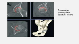Pre operative
planning of the
acetabular implant
 