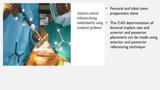 • Femoral and tibial stem
preparation done
• The CAS determination of
femoral implant size and
anterior and posterior
placement can be made using
anterior and posterior
referencing technique
 