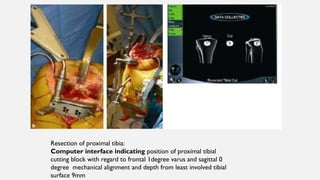 Resection of proximal tibia:
Computer interface indicating position of proximal tibial
cutting block with regard to frontal 1degree varus and sagittal 0
degree mechanical alignment and depth from least involved tibial
surface 9mm
 