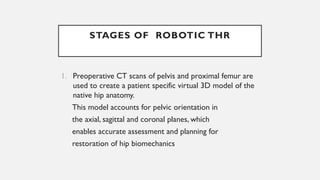 STAGES OF ROBOTIC THR
1. Preoperative CT scans of pelvis and proximal femur are
used to create a patient specific virtual 3D model of the
native hip anatomy.
This model accounts for pelvic orientation in
the axial, sagittal and coronal planes, which
enables accurate assessment and planning for
restoration of hip biomechanics
 