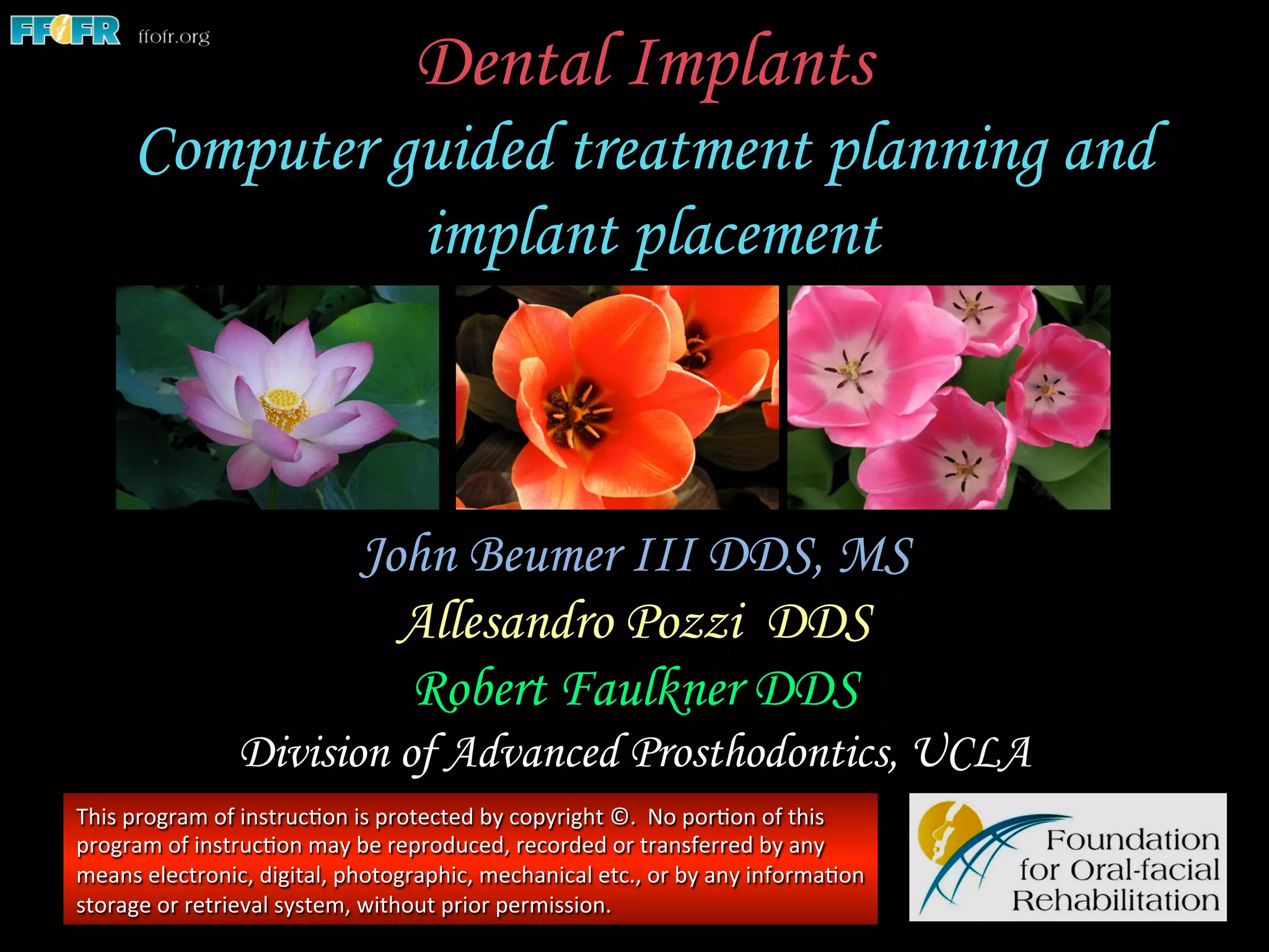 Dental Implants
Computer guided treatment planning and
implant placement
John Beumer III DDS, MS
Allesandro Pozzi DDS
Robert Faulkner DDS
Division of Advanced Prosthodontics, UCLA
This	
  program	
  of	
  instruc1on	
  is	
  protected	
  by	
  copyright	
  ©.	
  	
  No	
  por1on	
  of	
  this	
  
program	
  of	
  instruc1on	
  may	
  be	
  reproduced,	
  recorded	
  or	
  transferred	
  by	
  any	
  
means	
  electronic,	
  digital,	
  photographic,	
  mechanical	
  etc.,	
  or	
  by	
  any	
  informa1on	
  
storage	
  or	
  retrieval	
  system,	
  without	
  prior	
  permission.	
  
 