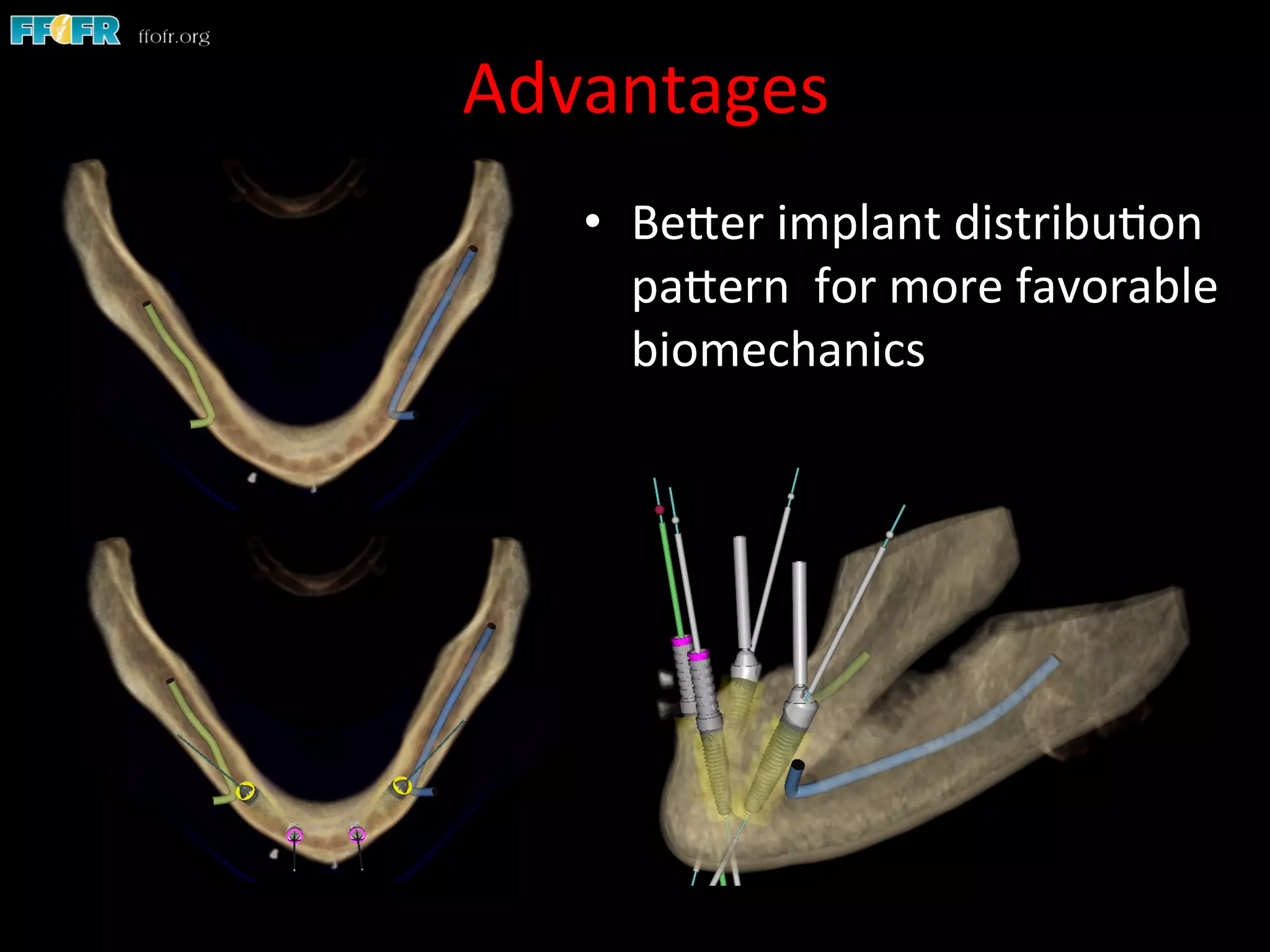 Advantages	
  
•  BeSer	
  implant	
  distribu1on	
  
paSern	
  	
  for	
  more	
  favorable	
  
biomechanics	
  
 