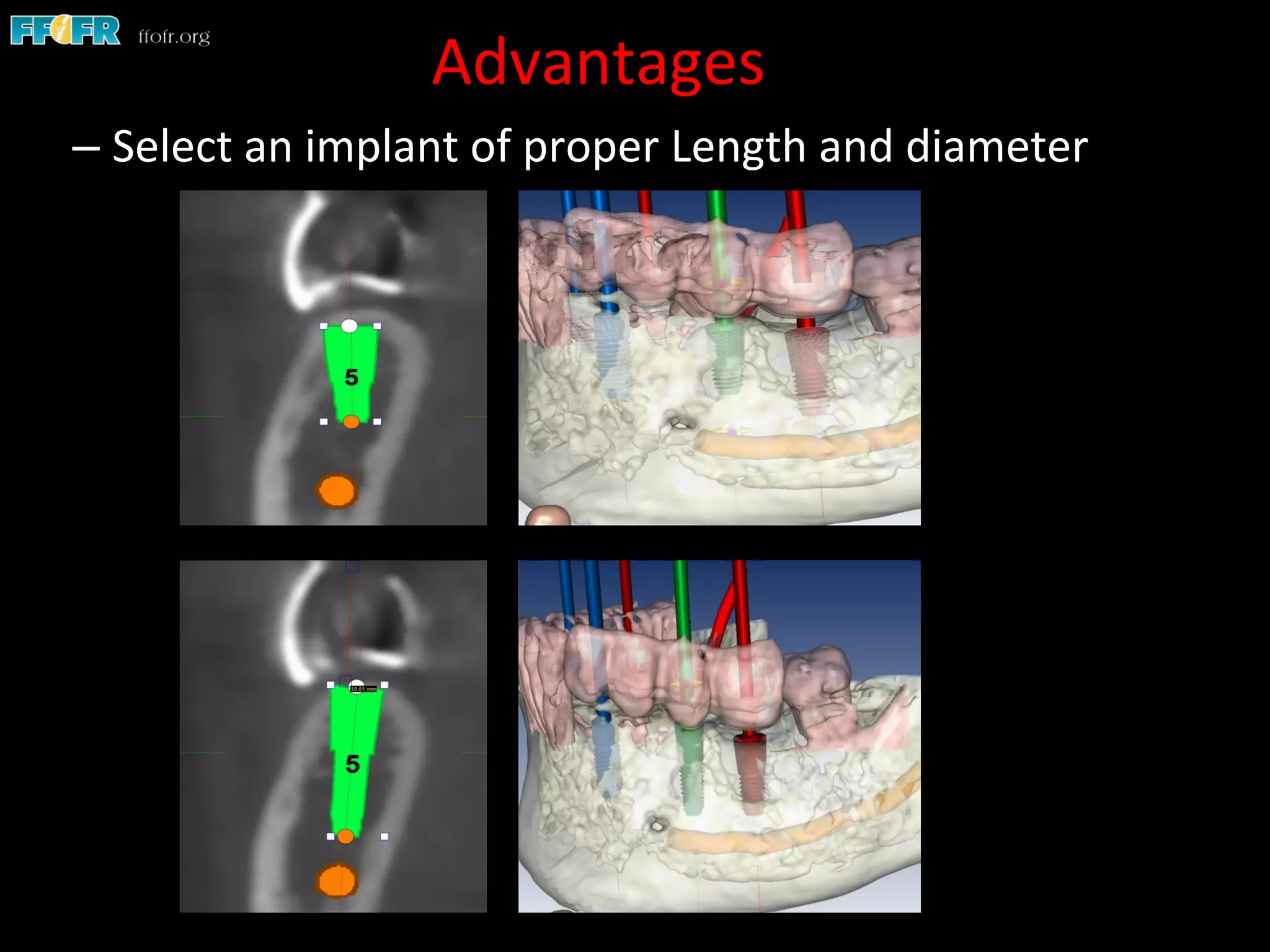 Advantages	
  
– Select	
  an	
  implant	
  of	
  proper	
  Length	
  and	
  diameter	
  
 