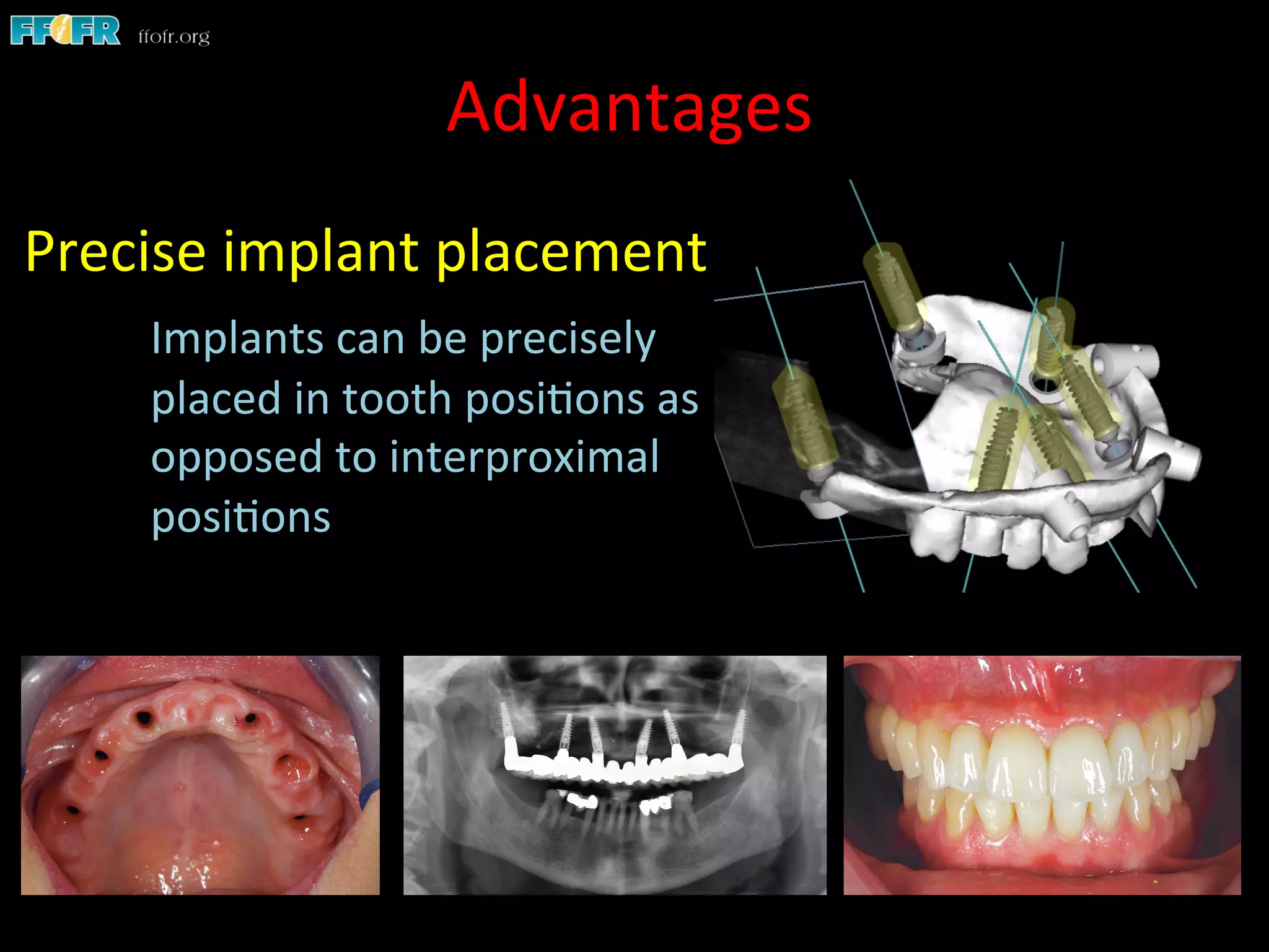 Advantages	
  
Precise	
  implant	
  placement	
  
	
  Implants	
  can	
  be	
  precisely	
  	
  
	
  placed	
  in	
  tooth	
  posi1ons	
  as	
  
	
  opposed	
  to	
  interproximal	
  
	
  posi1ons	
  
 