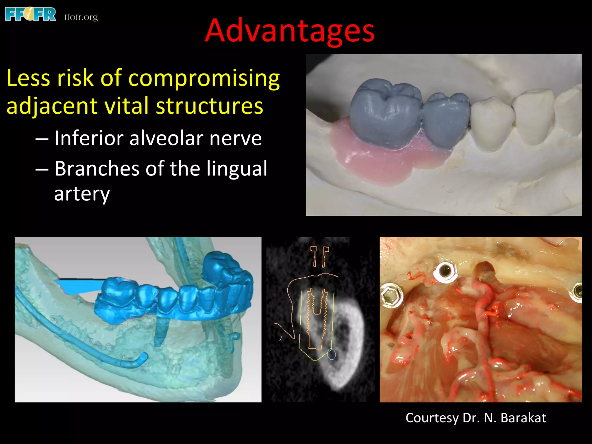 Advantages	
  
Less	
  risk	
  of	
  compromising	
  
adjacent	
  vital	
  structures	
  
– Inferior	
  alveolar	
  nerve	
  
– Branches	
  of	
  the	
  lingual	
  
artery	
  
Courtesy	
  Dr.	
  N.	
  Barakat	
  
 