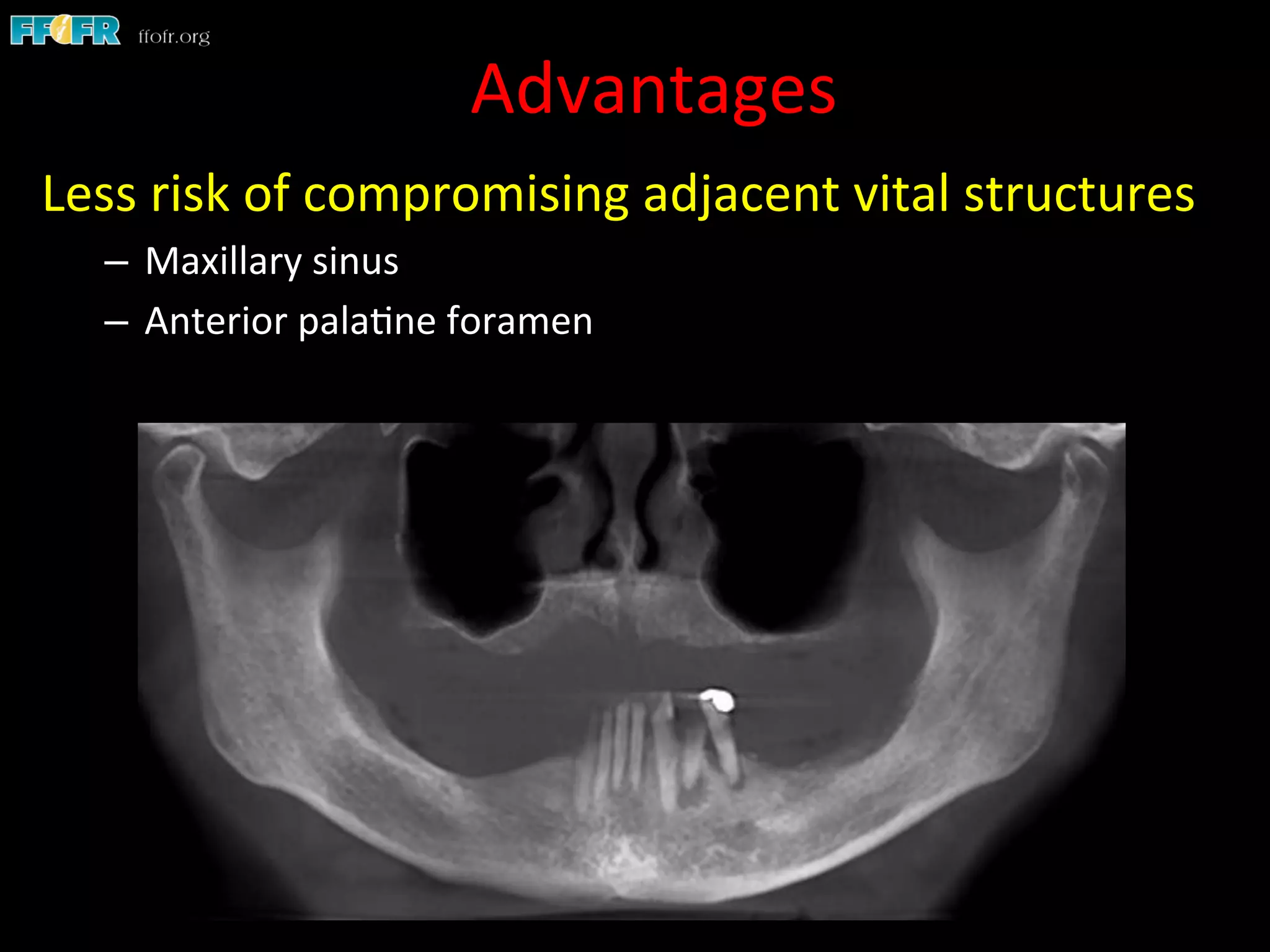 Advantages	
  
Less	
  risk	
  of	
  compromising	
  adjacent	
  vital	
  structures	
  
–  Maxillary	
  sinus	
  
–  Anterior	
  pala1ne	
  foramen	
  
 