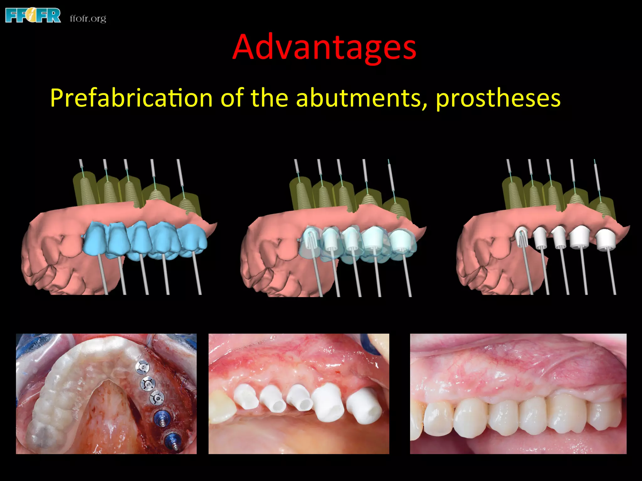 Advantages	
  
Prefabrica1on	
  of	
  the	
  abutments,	
  prostheses	
  	
  
 
