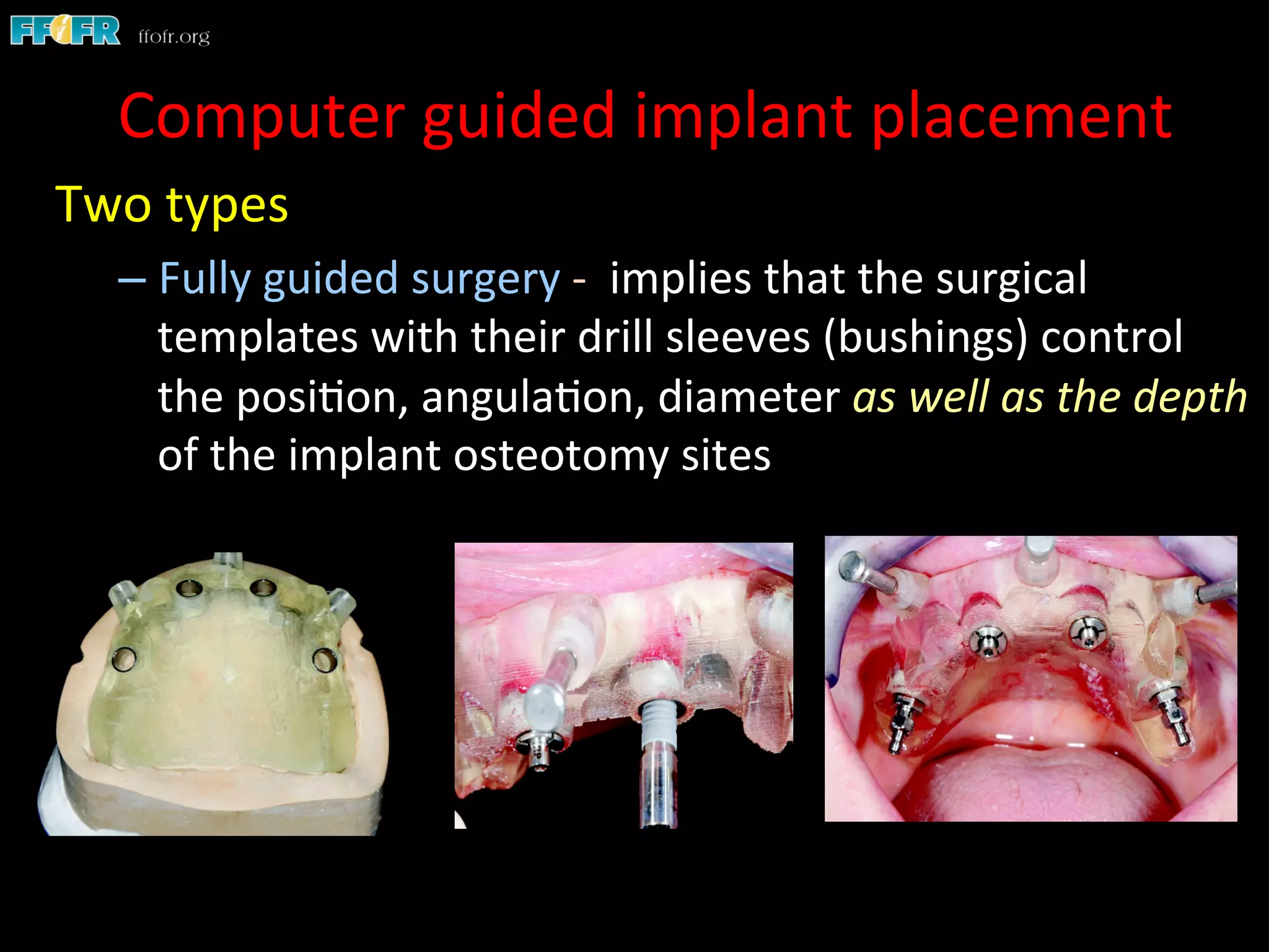 Two	
  types	
  
– Fully	
  guided	
  surgery	
  -­‐	
  	
  implies	
  that	
  the	
  surgical	
  
templates	
  with	
  their	
  drill	
  sleeves	
  (bushings)	
  control	
  
the	
  posi1on,	
  angula1on,	
  diameter	
  as	
  well	
  as	
  the	
  depth	
  
of	
  the	
  implant	
  osteotomy	
  sites	
  
Computer	
  guided	
  implant	
  placement	
  
 