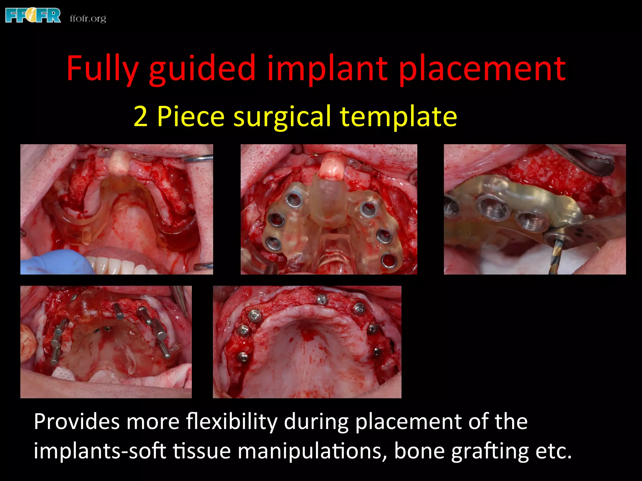 Fully	
  guided	
  implant	
  placement	
  
Provides	
  more	
  ﬂexibility	
  during	
  placement	
  of	
  the	
  
implants-­‐soC	
  1ssue	
  manipula1ons,	
  bone	
  graCing	
  etc.	
  
2	
  Piece	
  surgical	
  template	
  
 