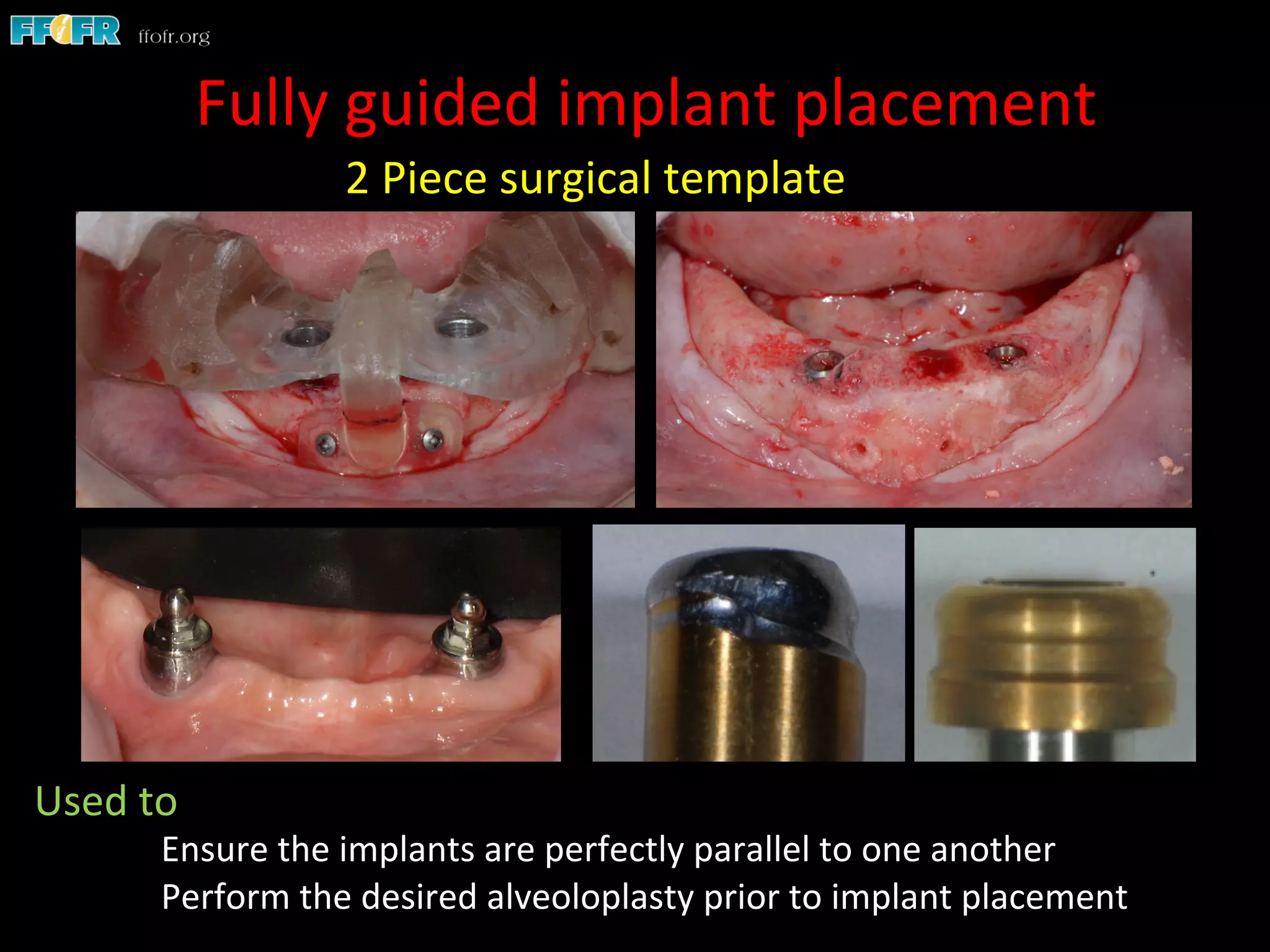  2	
  Piece	
  surgical	
  template	
  
Fully	
  guided	
  implant	
  placement	
  
Used	
  to	
  	
  
	
  Ensure	
  the	
  implants	
  are	
  perfectly	
  parallel	
  to	
  one	
  another	
  
	
  Perform	
  the	
  desired	
  alveoloplasty	
  prior	
  to	
  implant	
  placement	
  
 