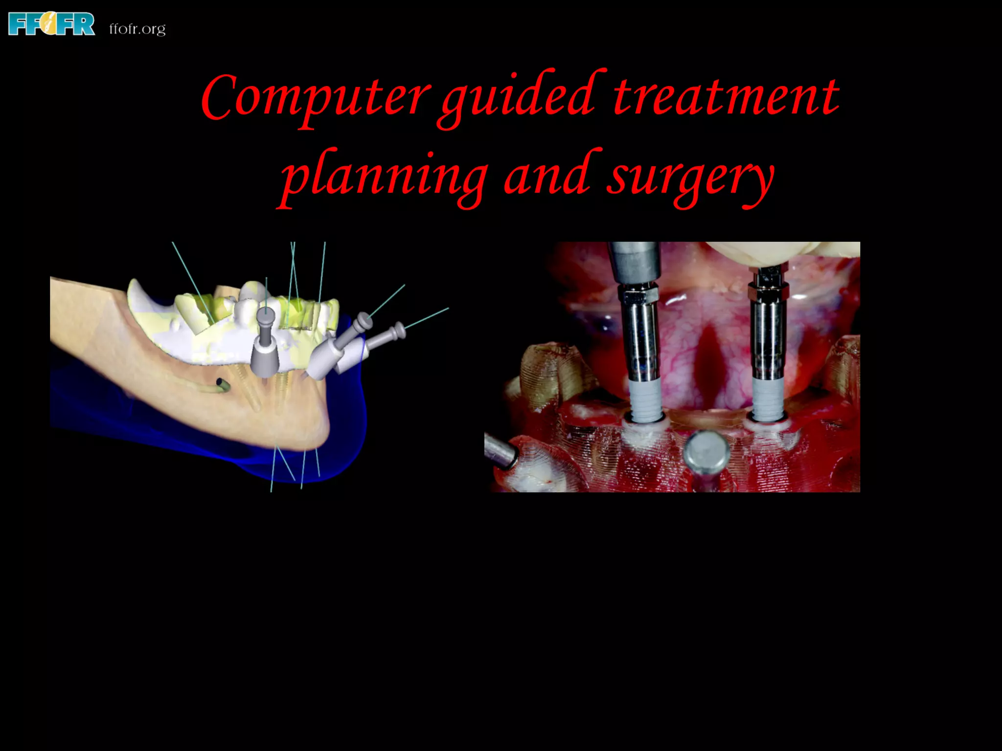 Computer guided treatment
planning and surgery
 