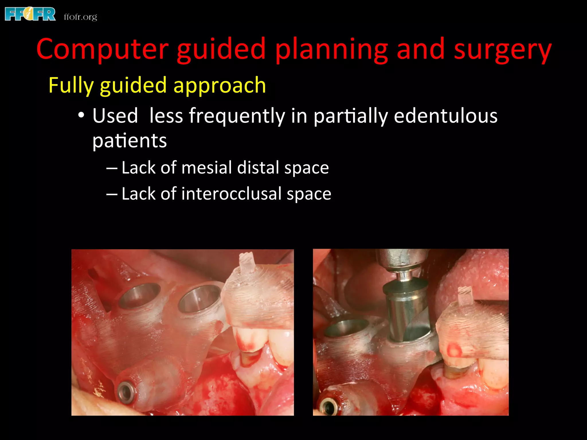 Fully	
  guided	
  approach	
  
•  Used	
  	
  less	
  frequently	
  in	
  par1ally	
  edentulous	
  
pa1ents	
  
– Lack	
  of	
  mesial	
  distal	
  space	
  
– Lack	
  of	
  interocclusal	
  space	
  
	
  
Computer	
  guided	
  planning	
  and	
  surgery	
  
 