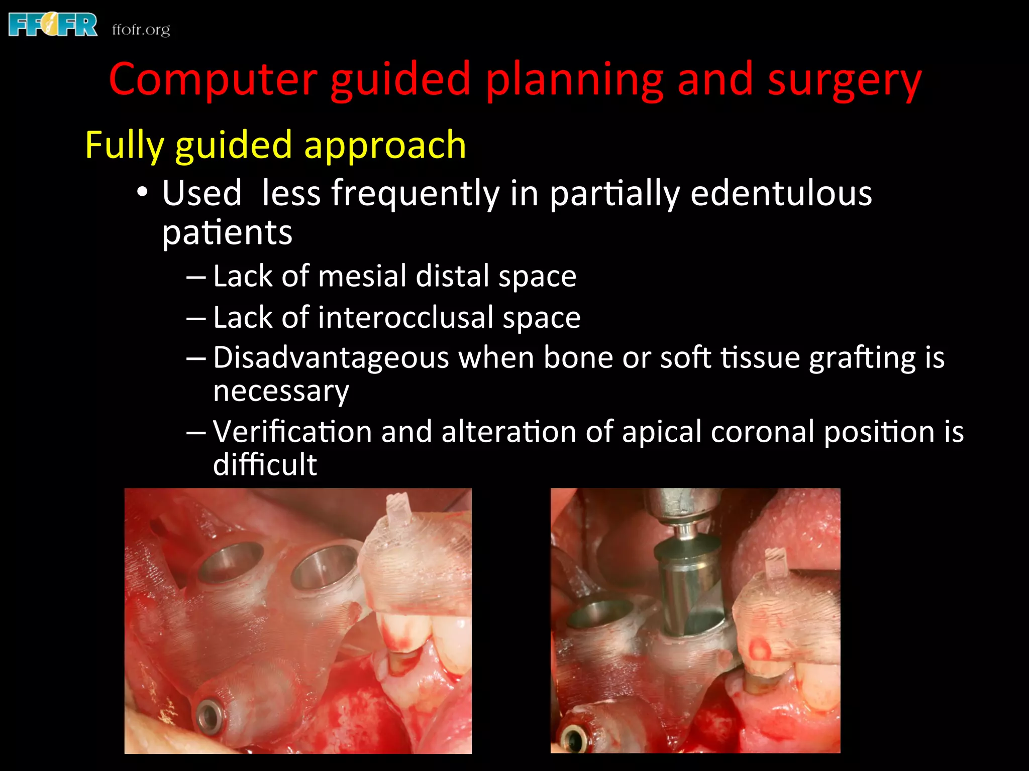 Fully	
  guided	
  approach	
  
•  Used	
  	
  less	
  frequently	
  in	
  par1ally	
  edentulous	
  
pa1ents	
  
– Lack	
  of	
  mesial	
  distal	
  space	
  
– Lack	
  of	
  interocclusal	
  space	
  
– Disadvantageous	
  when	
  bone	
  or	
  soC	
  1ssue	
  graCing	
  is	
  
necessary	
  
– Veriﬁca1on	
  and	
  altera1on	
  of	
  apical	
  coronal	
  posi1on	
  is	
  
diﬃcult	
  
	
  
Computer	
  guided	
  planning	
  and	
  surgery	
  
 