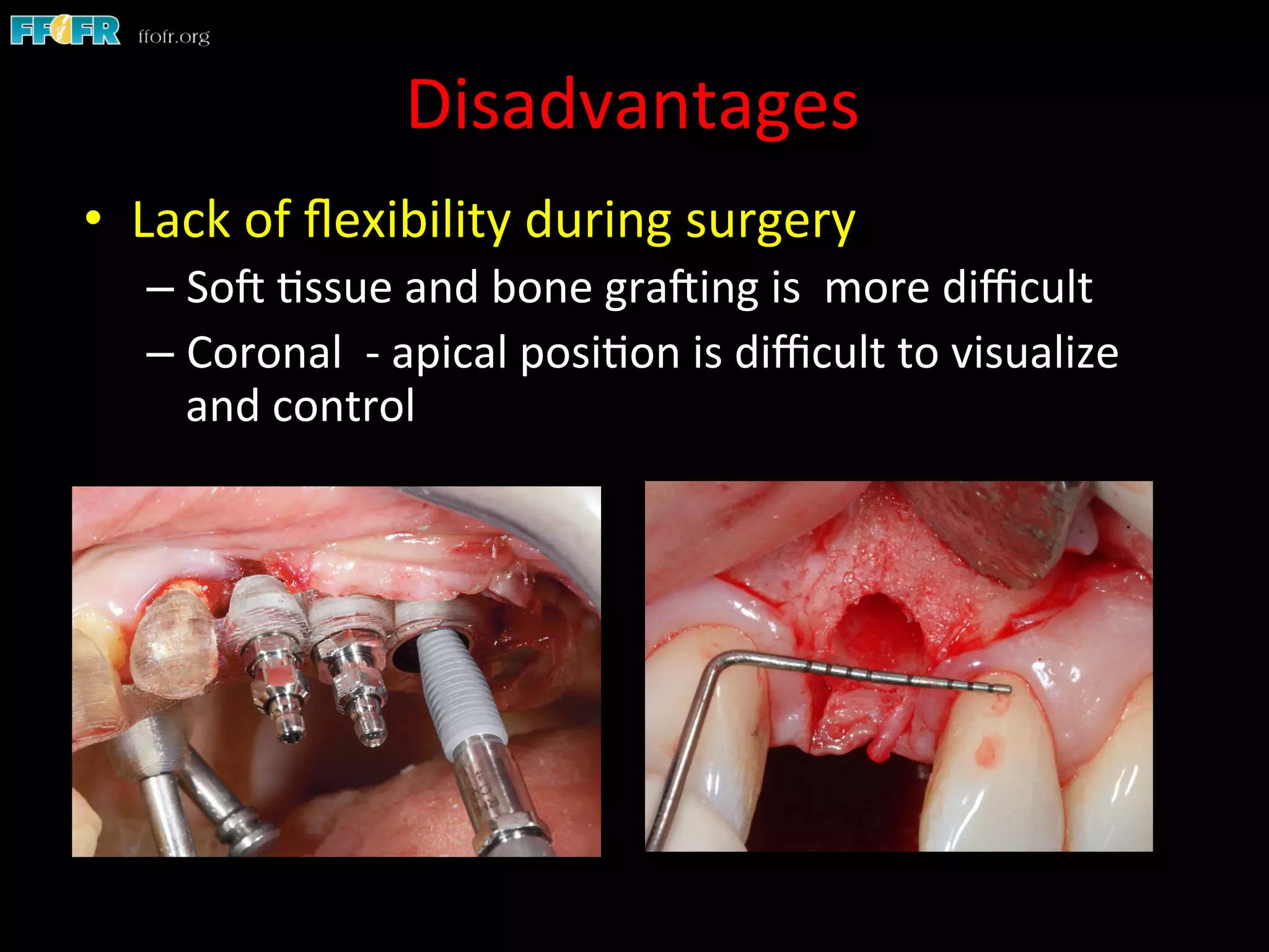 Disadvantages	
  
•  Lack	
  of	
  ﬂexibility	
  during	
  surgery	
  
– SoC	
  1ssue	
  and	
  bone	
  graCing	
  is	
  	
  more	
  diﬃcult	
  
– Coronal	
  	
  -­‐	
  apical	
  posi1on	
  is	
  diﬃcult	
  to	
  visualize	
  
and	
  control	
  
 