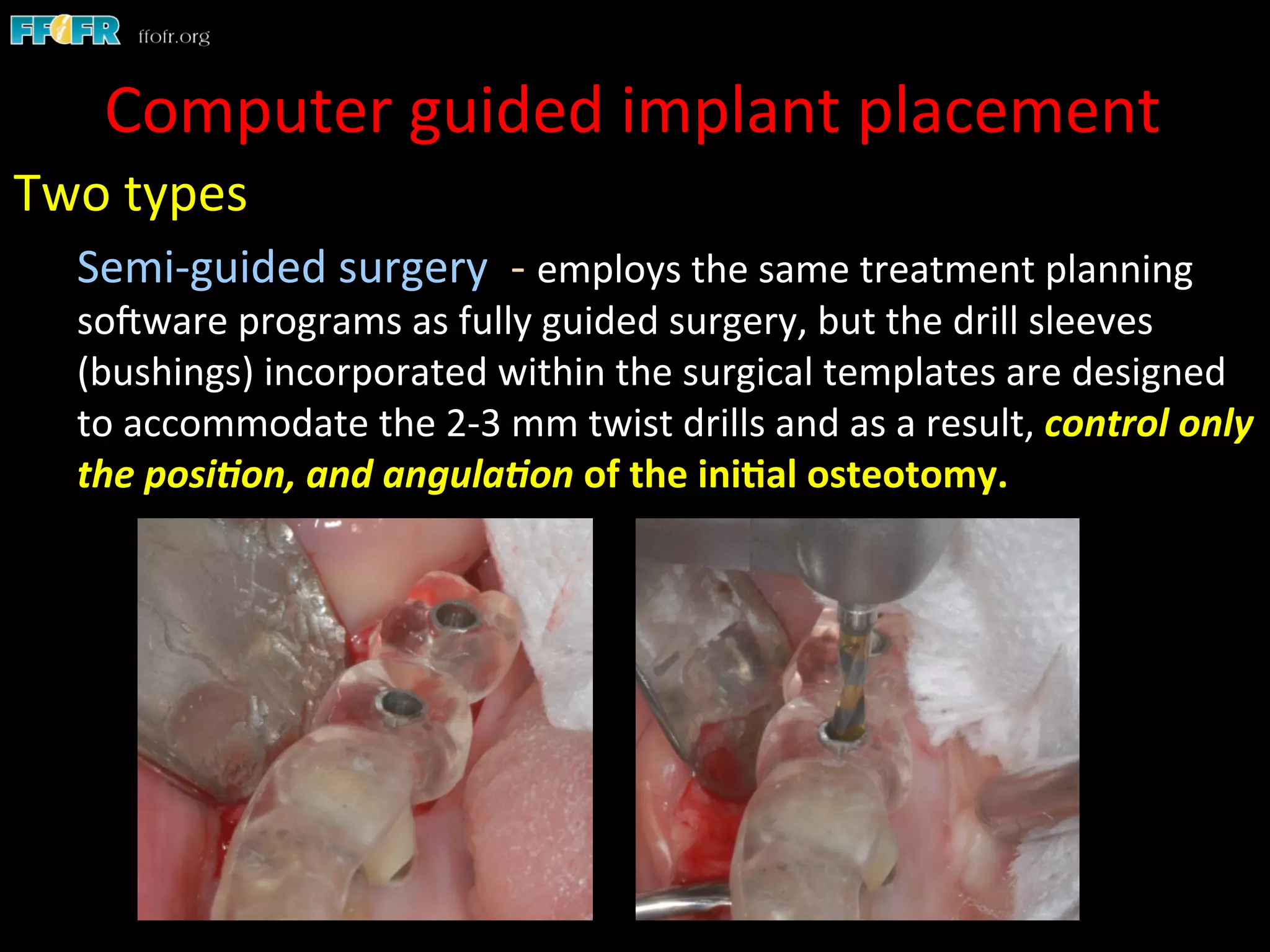 Two	
  types	
  
Semi-­‐guided	
  surgery	
  	
  -­‐	
  employs	
  the	
  same	
  treatment	
  planning	
  
soCware	
  programs	
  as	
  fully	
  guided	
  surgery,	
  but	
  the	
  drill	
  sleeves	
  
(bushings)	
  incorporated	
  within	
  the	
  surgical	
  templates	
  are	
  designed	
  
to	
  accommodate	
  the	
  2-­‐3	
  mm	
  twist	
  drills	
  and	
  as	
  a	
  result,	
  control	
  only	
  
the	
  posi.on,	
  and	
  angula.on	
  of	
  the	
  ini)al	
  osteotomy.	
  
Computer	
  guided	
  implant	
  placement	
  
 
