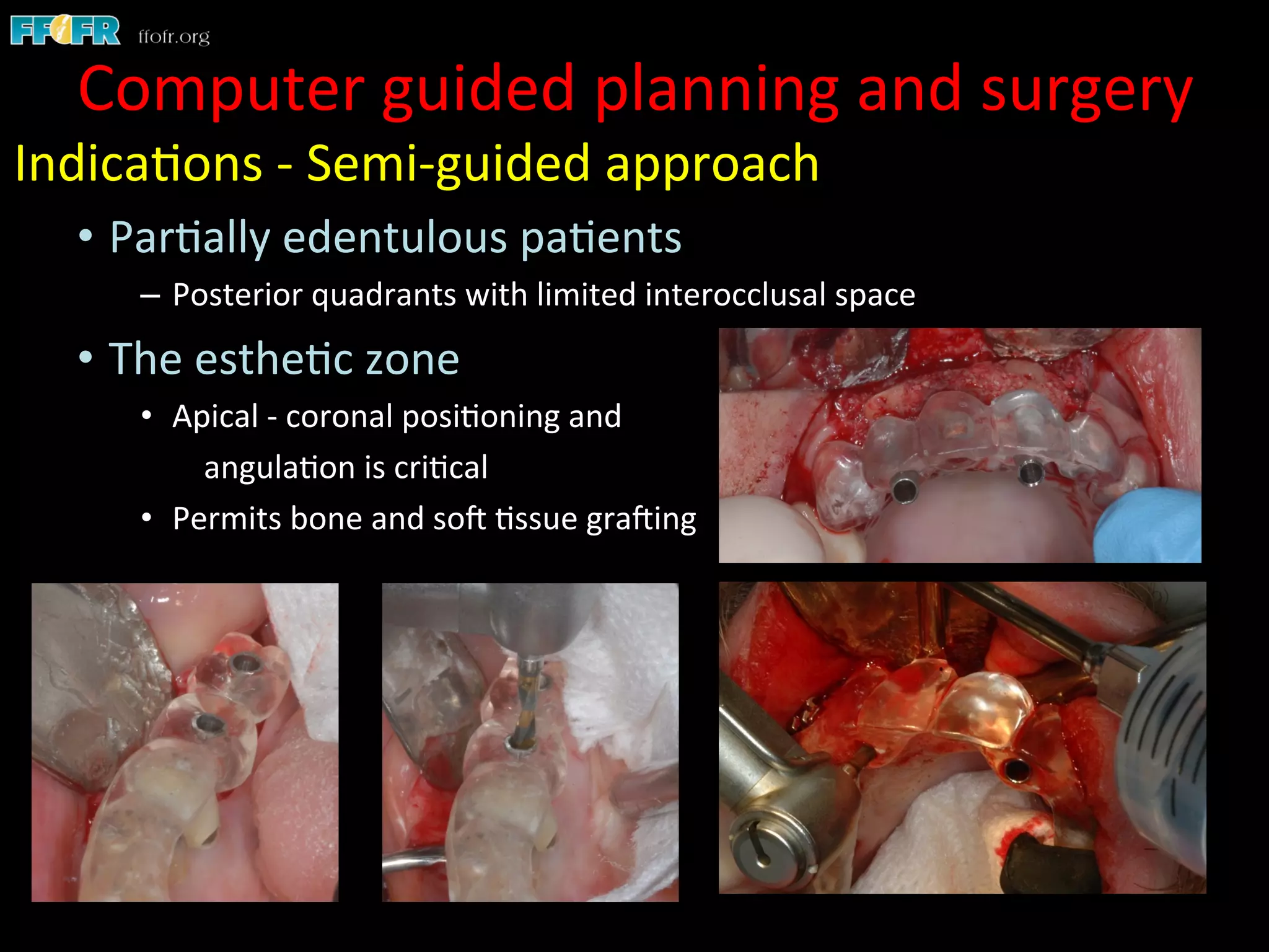 Indica1ons	
  -­‐	
  Semi-­‐guided	
  approach	
  
•  Par1ally	
  edentulous	
  pa1ents	
  
–  Posterior	
  quadrants	
  with	
  limited	
  interocclusal	
  space	
  
•  The	
  esthe1c	
  zone	
  
•  Apical	
  -­‐	
  coronal	
  posi1oning	
  and	
  	
  
	
  angula1on	
  is	
  cri1cal	
  
•  Permits	
  bone	
  and	
  soC	
  1ssue	
  graCing	
  
	
  
Computer	
  guided	
  planning	
  and	
  surgery	
  
 