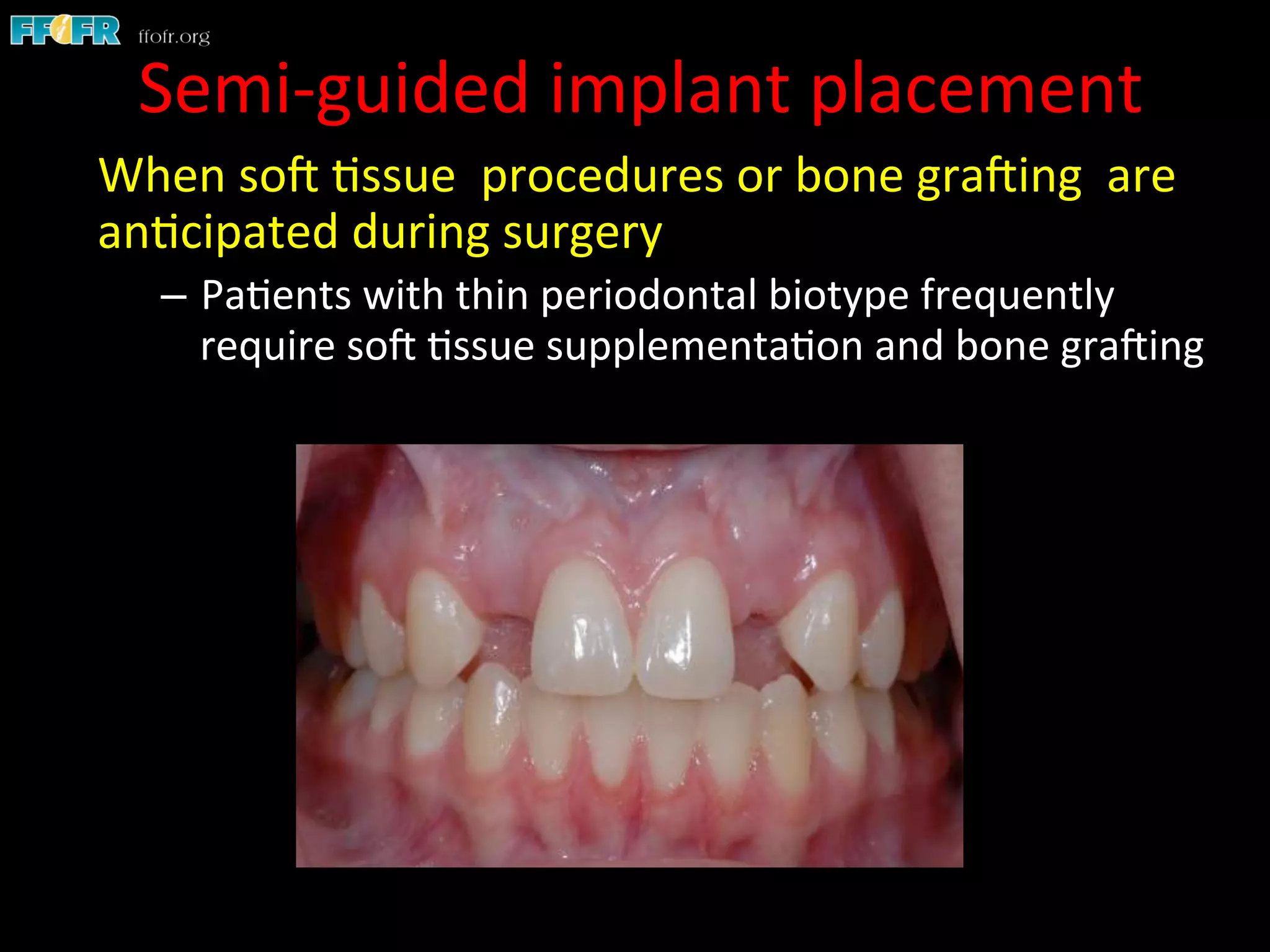 Semi-­‐guided	
  implant	
  placement	
  
When	
  soC	
  1ssue	
  	
  procedures	
  or	
  bone	
  graCing	
  	
  are	
  
an1cipated	
  during	
  surgery	
  
–  Pa1ents	
  with	
  thin	
  periodontal	
  biotype	
  frequently	
  
require	
  soC	
  1ssue	
  supplementa1on	
  and	
  bone	
  graCing	
  
 