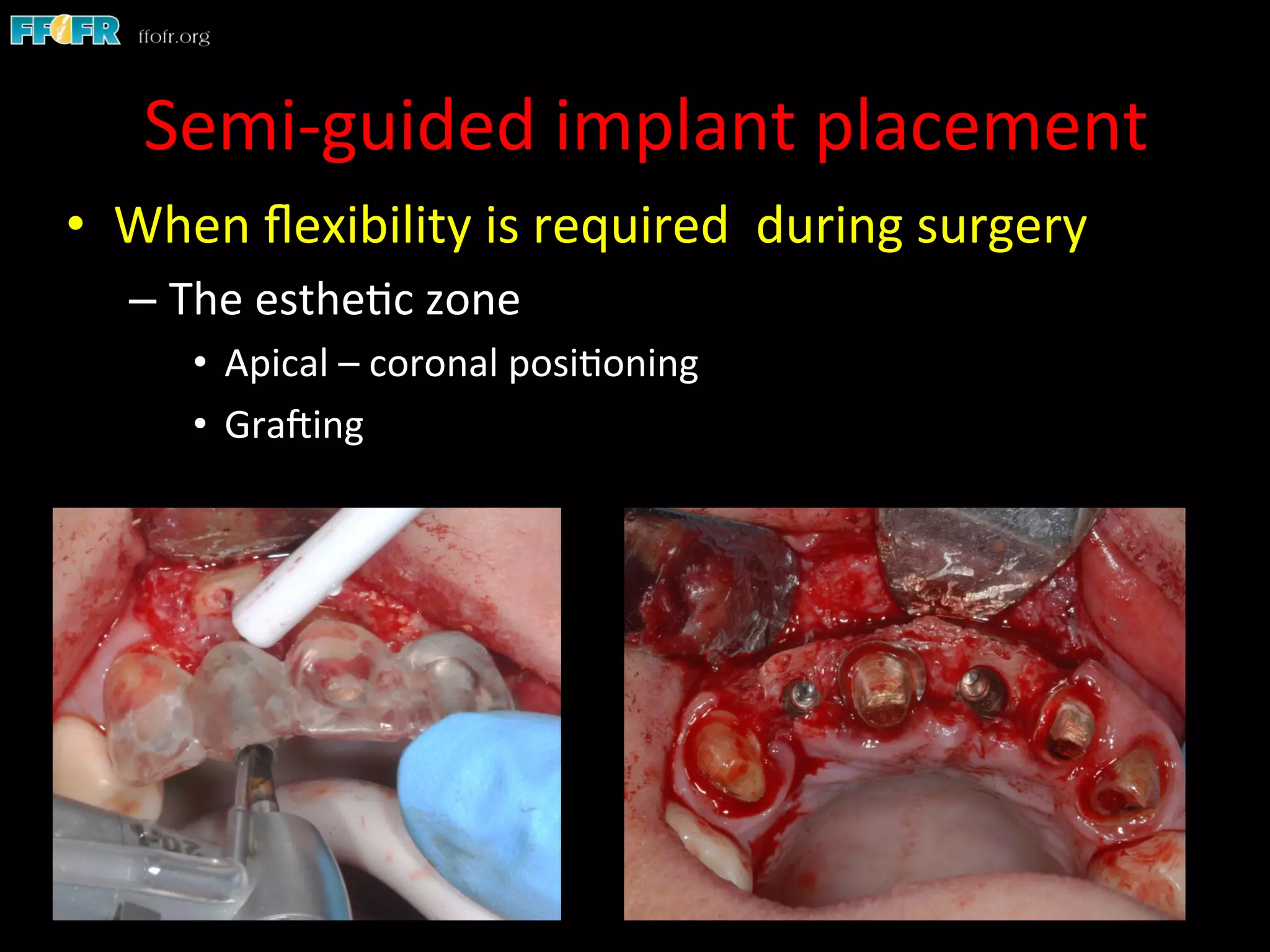 •  When	
  ﬂexibility	
  is	
  required	
  	
  during	
  surgery	
  
– The	
  esthe1c	
  zone	
  
•  Apical	
  –	
  coronal	
  posi1oning	
  
•  GraCing	
  
Semi-­‐guided	
  implant	
  placement	
  
 