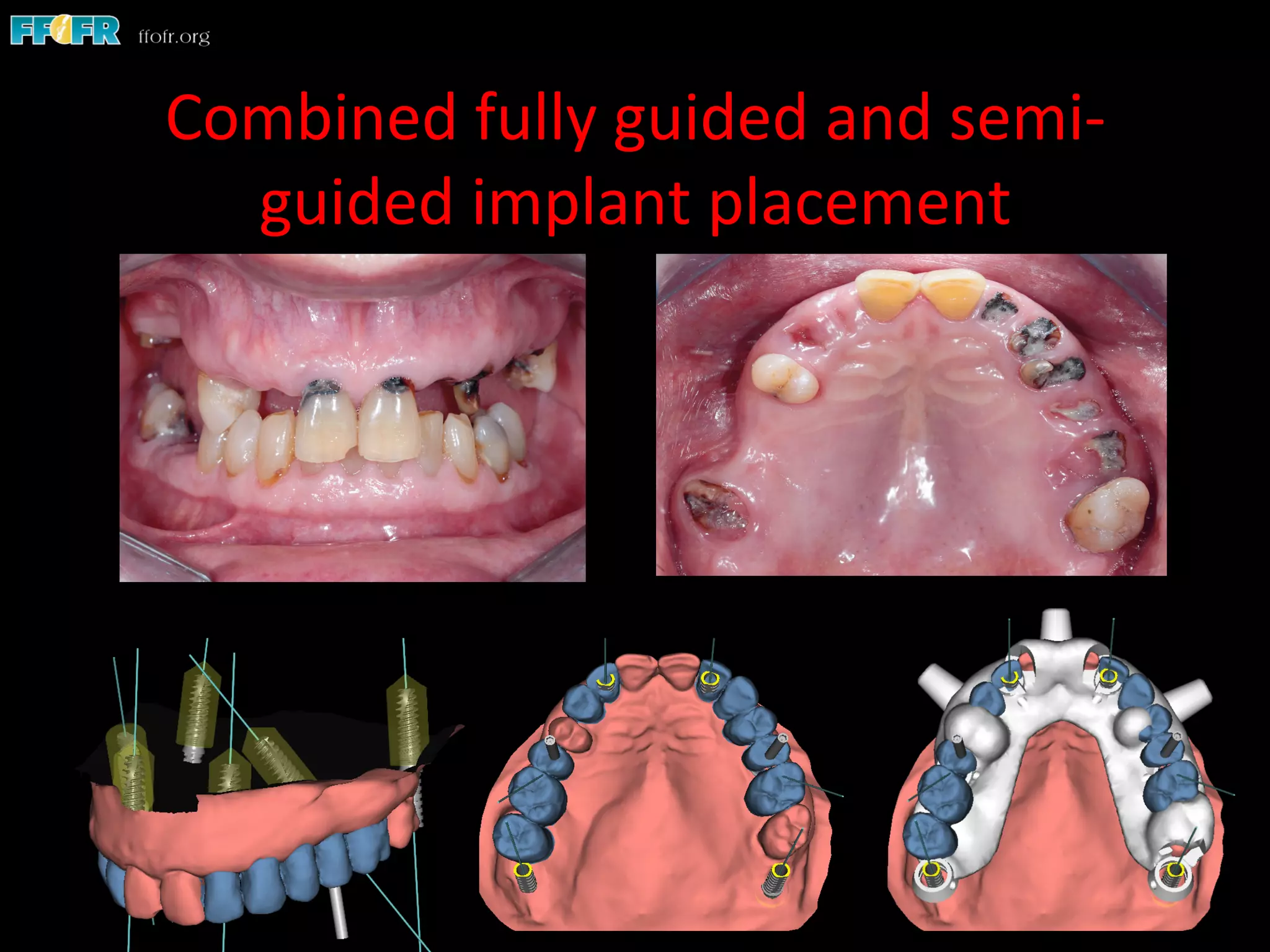 Combined	
  fully	
  guided	
  and	
  semi-­‐
guided	
  implant	
  placement	
  
 