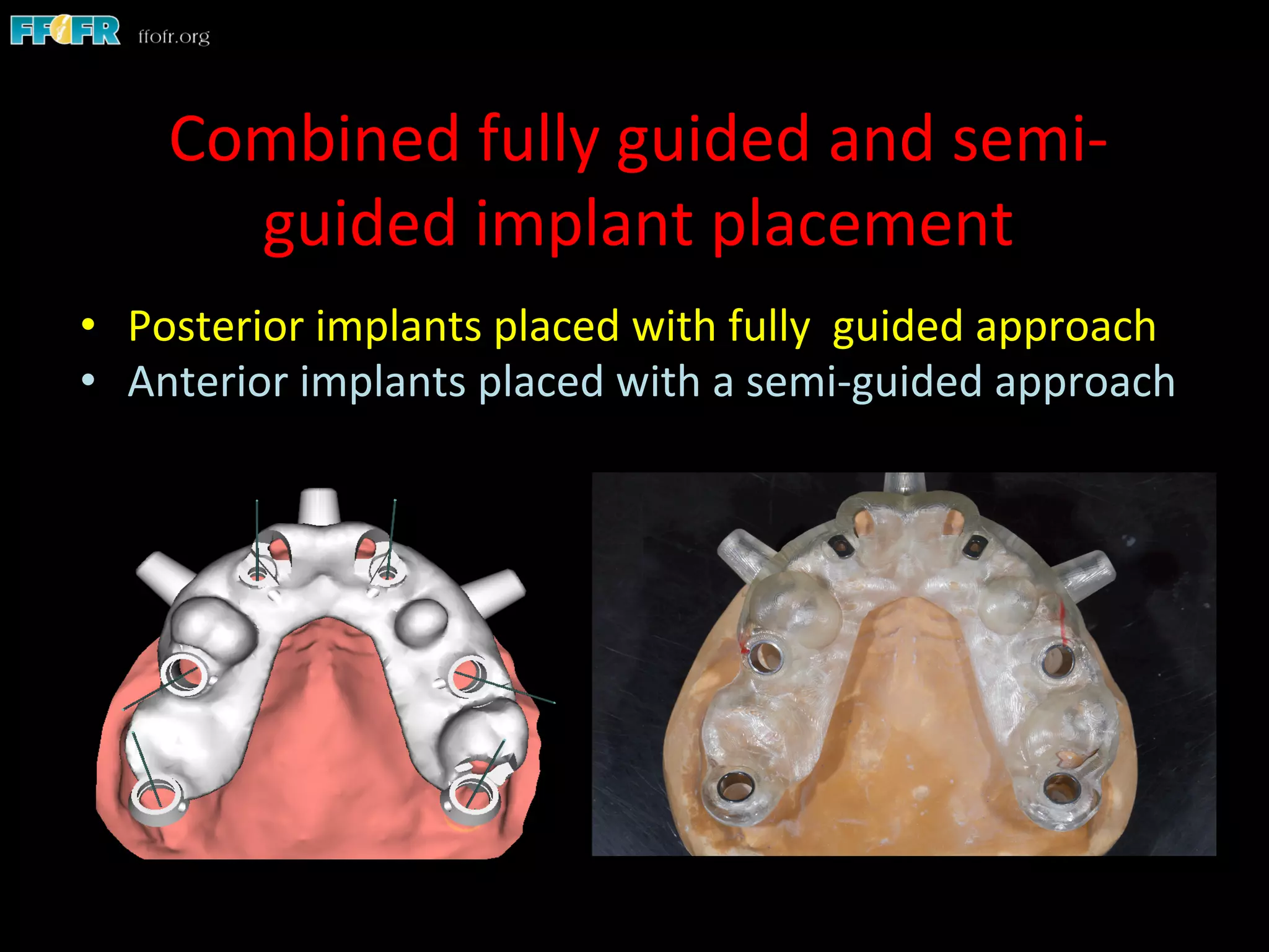 Combined	
  fully	
  guided	
  and	
  semi-­‐
guided	
  implant	
  placement	
  
•  Posterior	
  implants	
  placed	
  with	
  fully	
  	
  guided	
  approach	
  
•  Anterior	
  implants	
  placed	
  with	
  a	
  semi-­‐guided	
  approach	
  
 