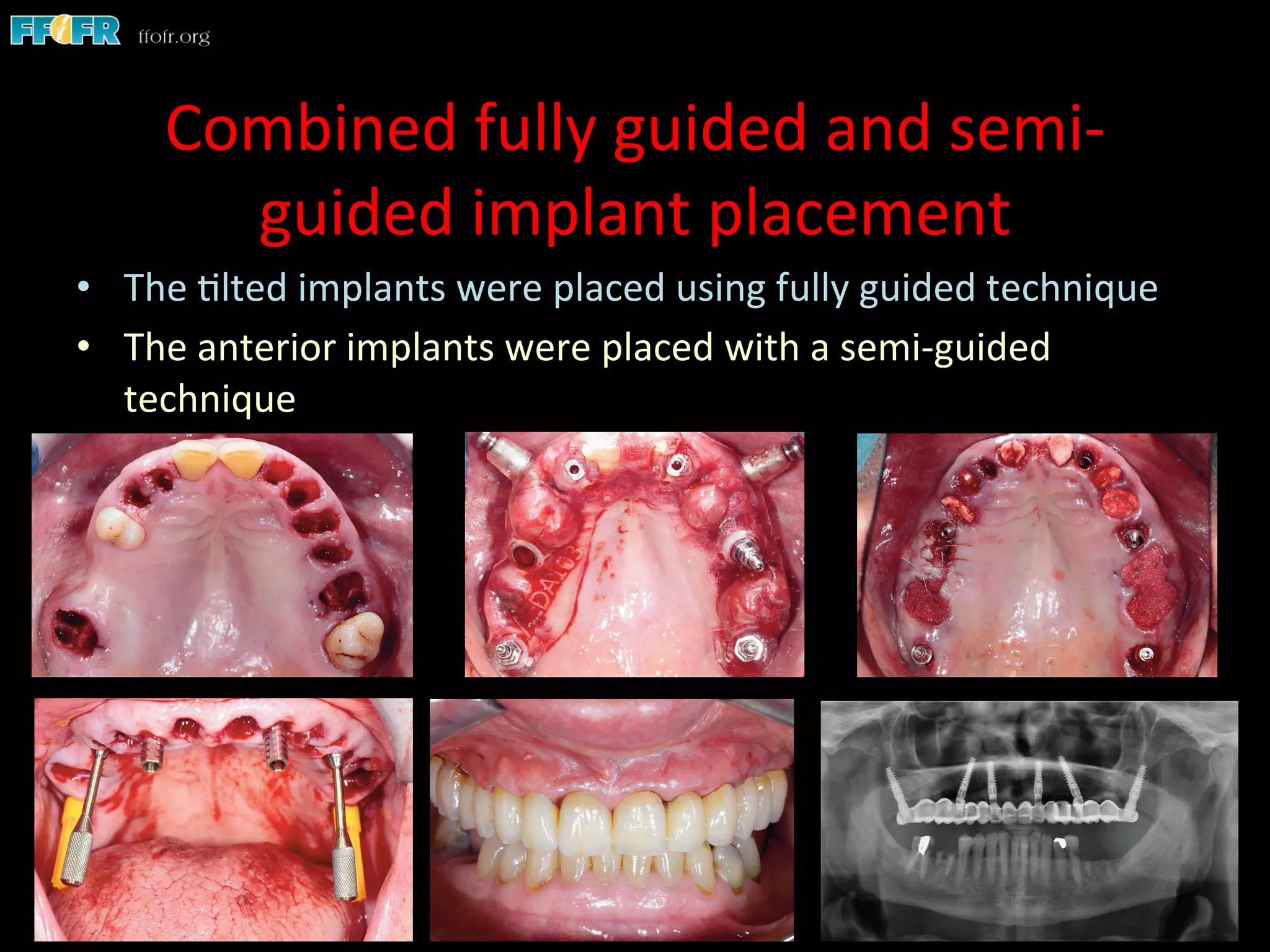Combined	
  fully	
  guided	
  and	
  semi-­‐
guided	
  implant	
  placement	
  
•  The	
  1lted	
  implants	
  were	
  placed	
  using	
  fully	
  guided	
  technique	
  
•  The	
  anterior	
  implants	
  were	
  placed	
  with	
  a	
  semi-­‐guided	
  
technique	
  
 