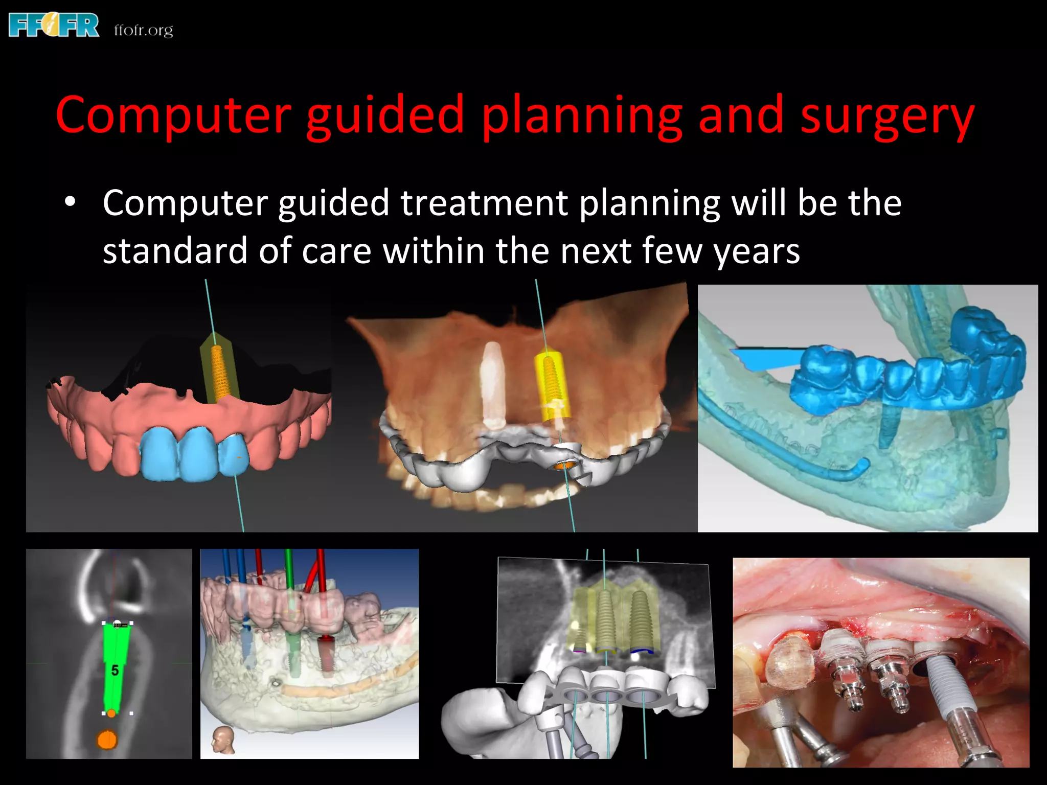 Computer	
  guided	
  planning	
  and	
  surgery	
  
•  Computer	
  guided	
  treatment	
  planning	
  will	
  be	
  the	
  
standard	
  of	
  care	
  within	
  the	
  next	
  few	
  years	
  
 