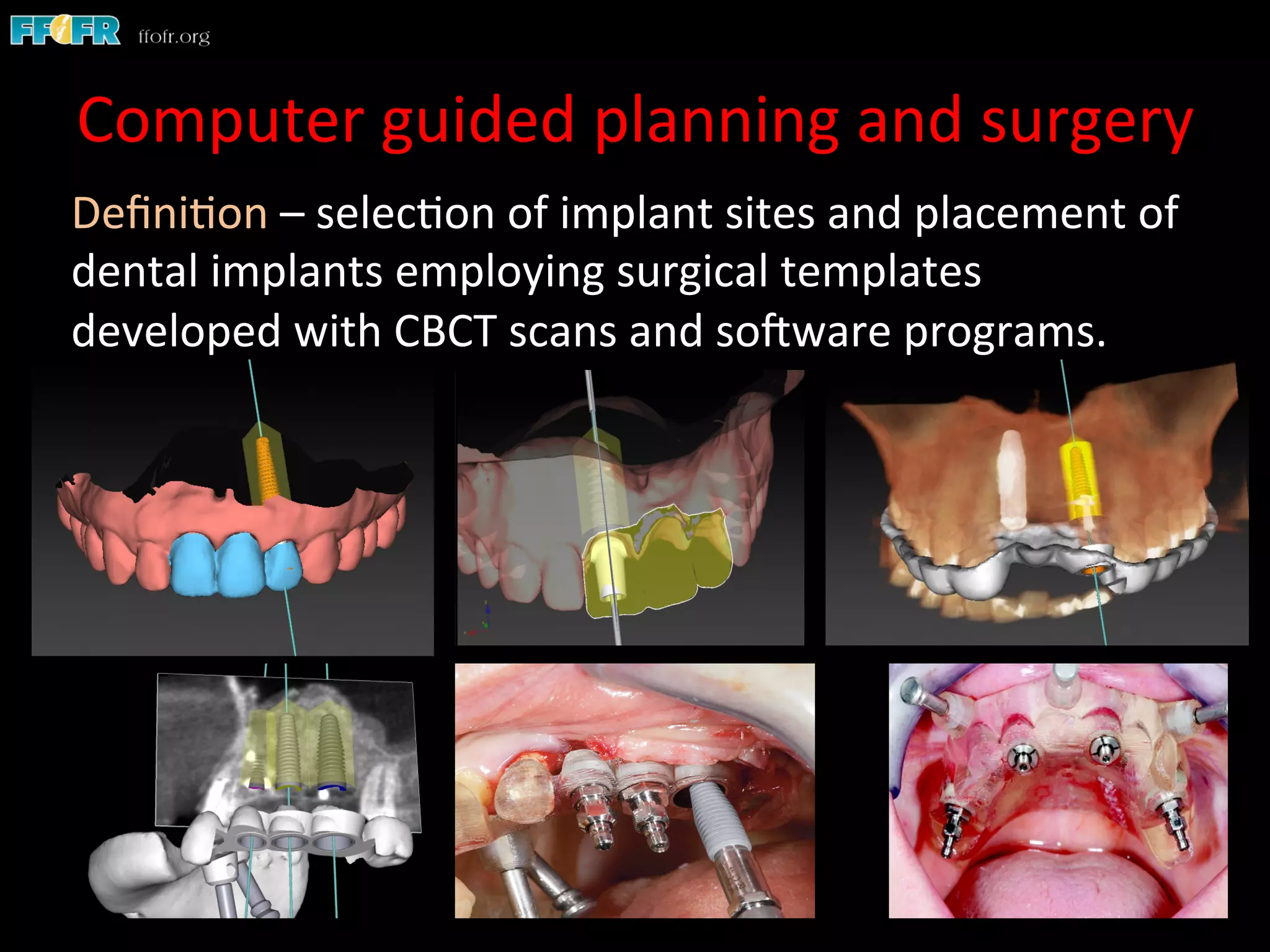 Computer	
  guided	
  planning	
  and	
  surgery	
  
Deﬁni1on	
  –	
  selec1on	
  of	
  implant	
  sites	
  and	
  placement	
  of	
  
dental	
  implants	
  employing	
  surgical	
  templates	
  
developed	
  with	
  CBCT	
  scans	
  and	
  soCware	
  programs.	
  	
  	
  	
  
 