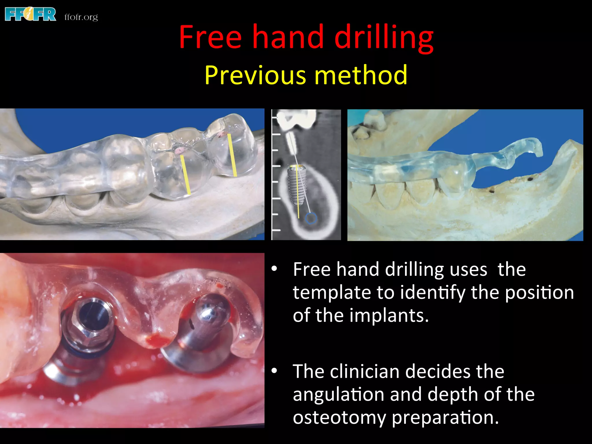 Free	
  hand	
  drilling	
  
Previous	
  method	
  
•  Free	
  hand	
  drilling	
  uses	
  	
  the	
  
template	
  to	
  iden1fy	
  the	
  posi1on	
  
of	
  the	
  implants.	
  	
  
•  The	
  clinician	
  decides	
  the	
  
angula1on	
  and	
  depth	
  of	
  the	
  
osteotomy	
  prepara1on.	
  
 