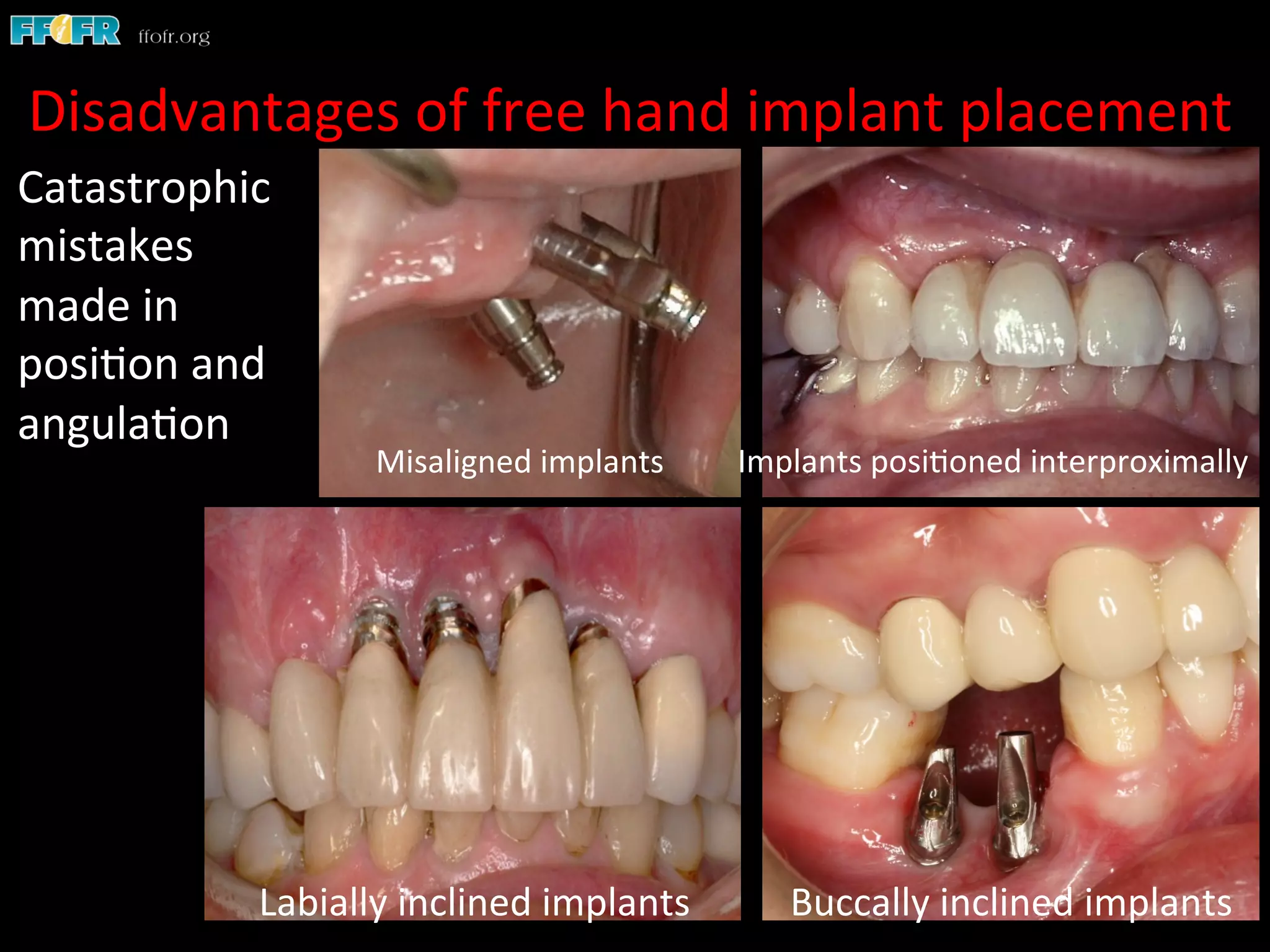 Disadvantages	
  of	
  free	
  hand	
  implant	
  placement	
  
Catastrophic	
  
mistakes	
  
made	
  in	
  
posi1on	
  and	
  
angula1on	
  
Labially	
  inclined	
  implants	
   Buccally	
  inclined	
  implants	
  
Implants	
  posi1oned	
  interproximally	
  Misaligned	
  implants	
  
 