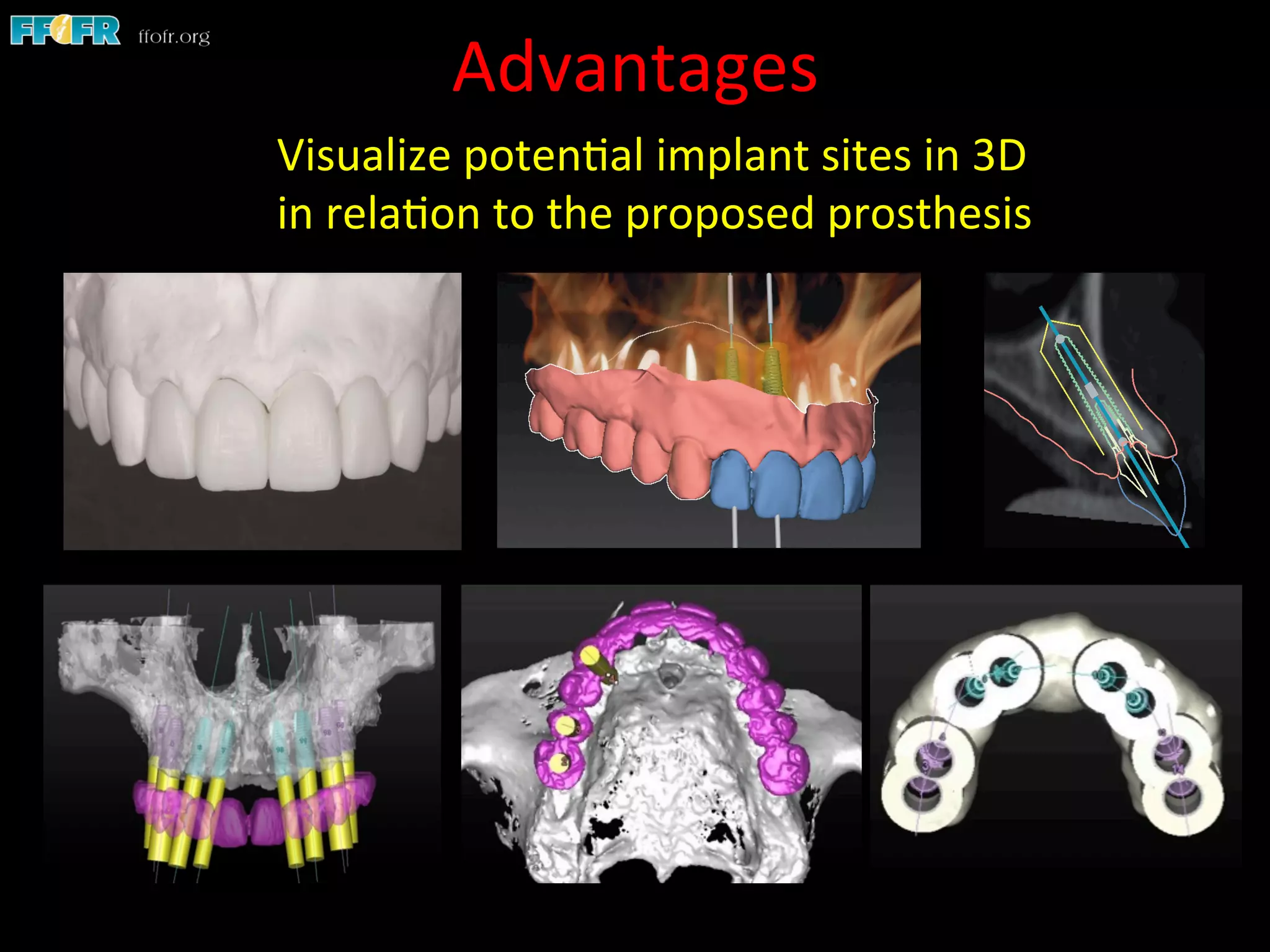 Advantages	
  
Visualize	
  poten1al	
  implant	
  sites	
  in	
  3D	
  
in	
  rela1on	
  to	
  the	
  proposed	
  prosthesis	
  
 