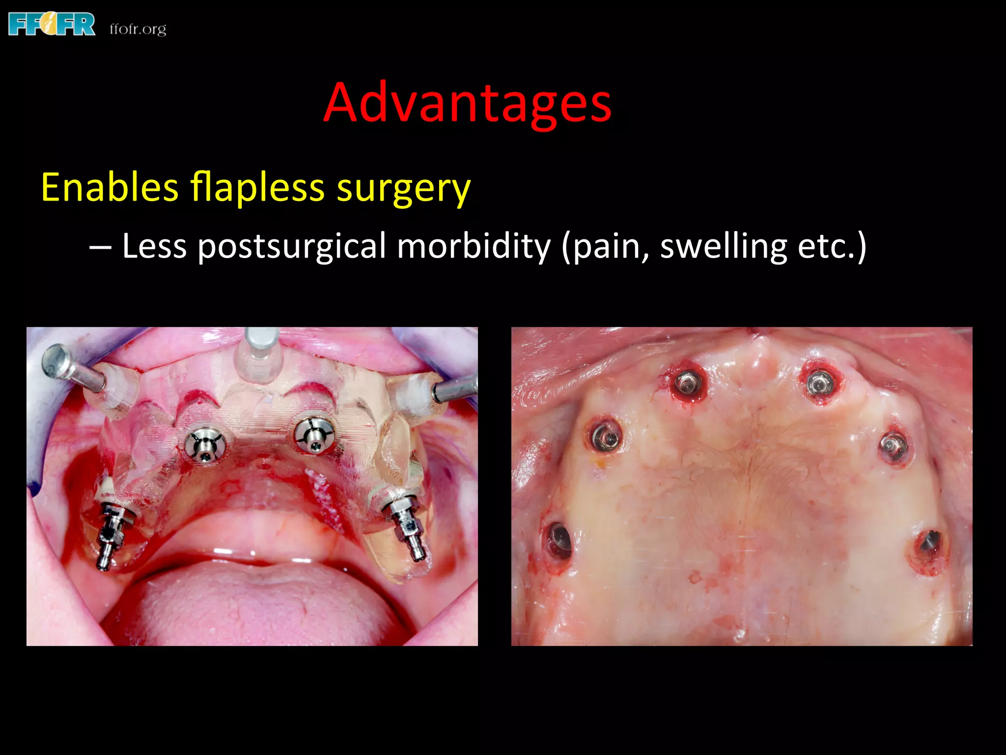 Advantages	
  
Enables	
  ﬂapless	
  surgery	
  
– Less	
  postsurgical	
  morbidity	
  (pain,	
  swelling	
  etc.)	
  
 