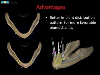 Advantages	
  
•  BeSer	
  implant	
  distribu1on	
  
paSern	
  	
  for	
  more	
  favorable	
  
biomechanics	
  
 