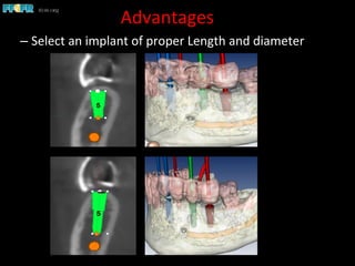 Advantages	
  
– Select	
  an	
  implant	
  of	
  proper	
  Length	
  and	
  diameter	
  
 