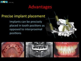 Advantages	
  
Precise	
  implant	
  placement	
  
	
  Implants	
  can	
  be	
  precisely	
  	
  
	
  placed	
  in	
  tooth	
  posi1ons	
  as	
  
	
  opposed	
  to	
  interproximal	
  
	
  posi1ons	
  
 