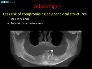 Advantages	
  
Less	
  risk	
  of	
  compromising	
  adjacent	
  vital	
  structures	
  
–  Maxillary	
  sinus	
  
–  Anterior	
  pala1ne	
  foramen	
  
 