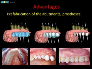 Advantages	
  
Prefabrica1on	
  of	
  the	
  abutments,	
  prostheses	
  	
  
 