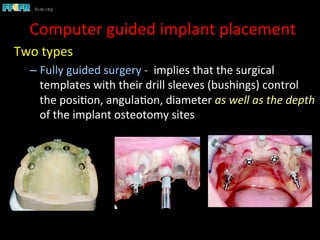 Two	
  types	
  
– Fully	
  guided	
  surgery	
  -­‐	
  	
  implies	
  that	
  the	
  surgical	
  
templates	
  with	
  their	
  drill	
  sleeves	
  (bushings)	
  control	
  
the	
  posi1on,	
  angula1on,	
  diameter	
  as	
  well	
  as	
  the	
  depth	
  
of	
  the	
  implant	
  osteotomy	
  sites	
  
Computer	
  guided	
  implant	
  placement	
  
 
